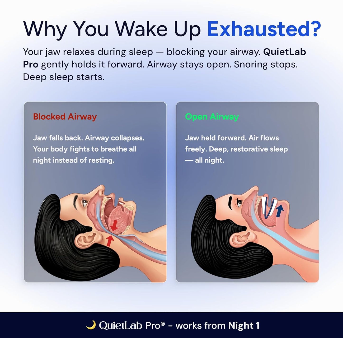 QuietLab Pro® Anti-Snoring Mouthpiece
